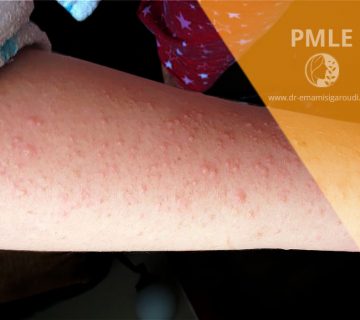 حساسیت به نور یا PMLE