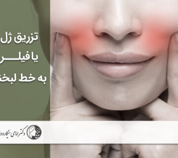 تزریق ژل و فیلر خط لبخند