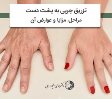 تزریق چربی دست