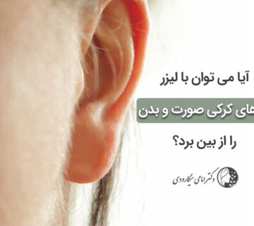 لیزر موهای کرکی
