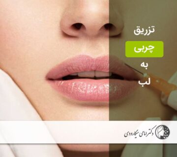 تزریق چربی به لب
