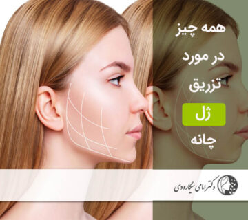 تزریق ژل به چانه