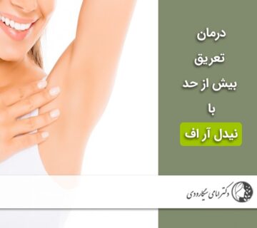 درمان تعریق با نیدل آر اف