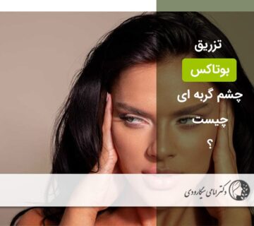بوتاکس چشم گربه‌ ای