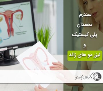 سندرم تخمدان پلی کیستیک