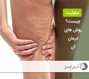 سلولیت