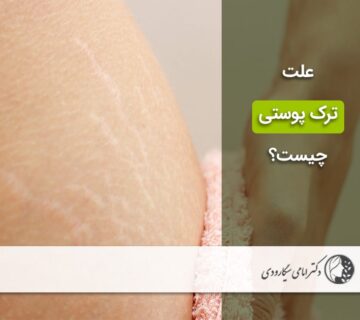 ترک پوستی