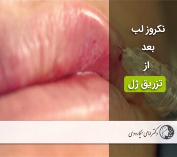 نکروز لب بعد از تزریق ژل