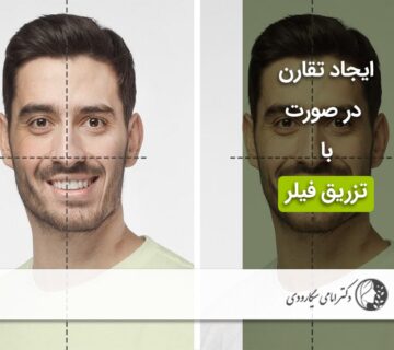 تقارن صورت با تزریق فیلر