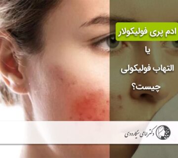 ادم پری فولیکولار