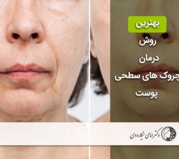 درمان چروک های سطحی پوست