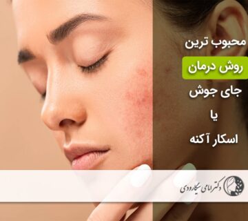 بهترین روش درمان جای جوش