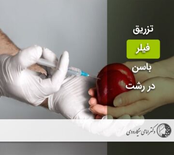 تزریق فیلر باسن در رشت