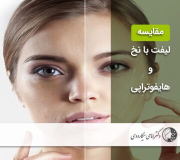 مقایسه لیفت با نخ و هایفوتراپی