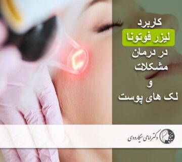 لیزر فوتونا
