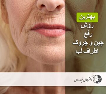 رفع چین و چروک اطراف لب