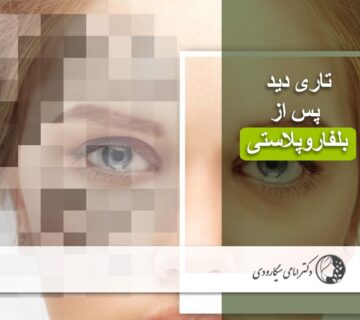 تاری دید پس از بلفاروپلاستی