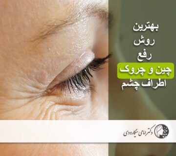 رفع چین و چروک اطراف چشم