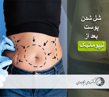 شل شدن پوست بعد از لیپوماتیک